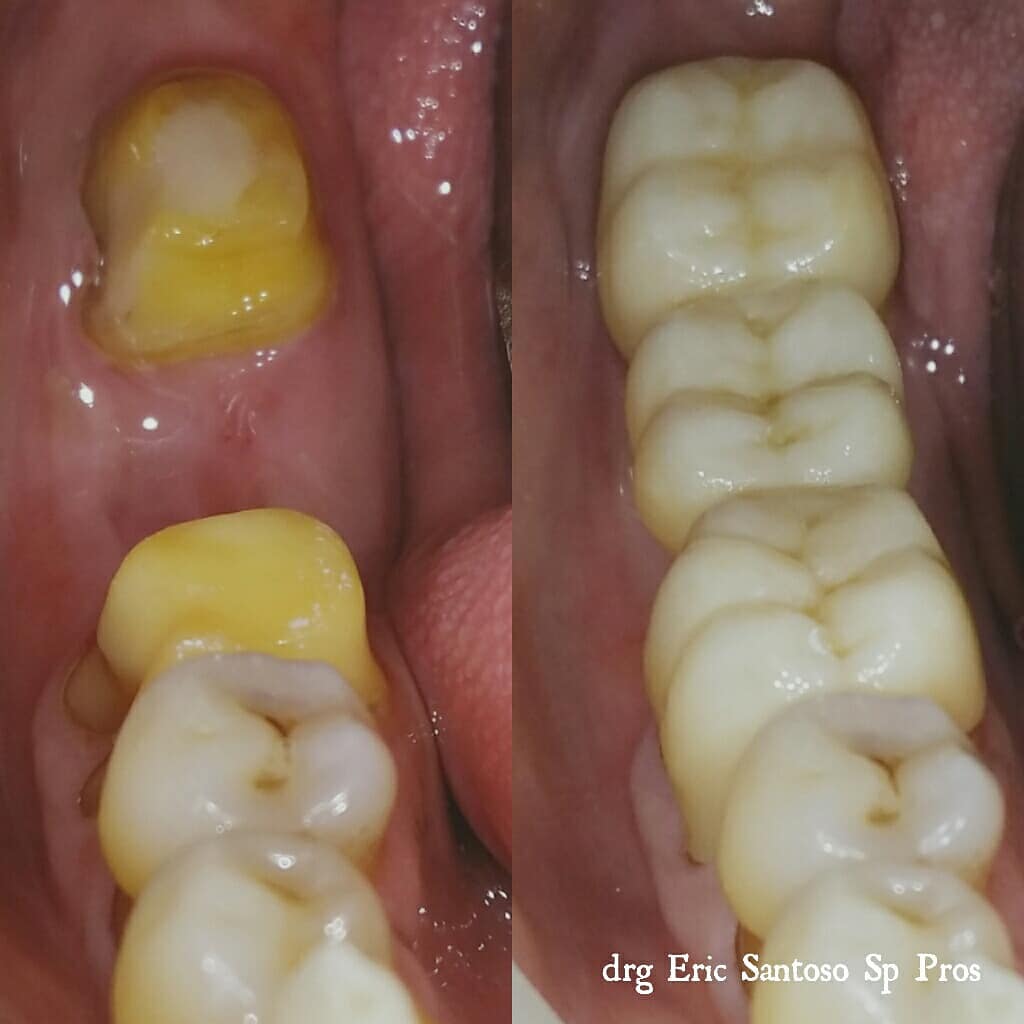 Dental bridge result